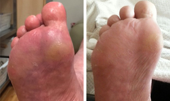 Post-Burn Skin — Before