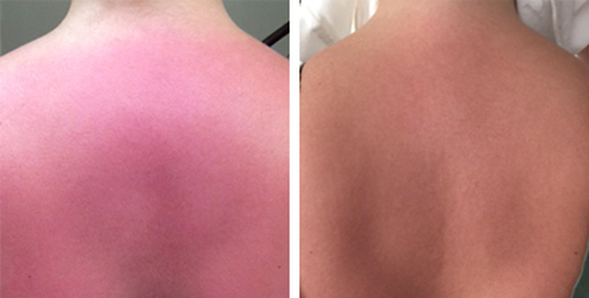 Severe Sunburn — Before